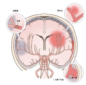 【訪問看護】脳梗塞後の暮らしを支える訪問看護