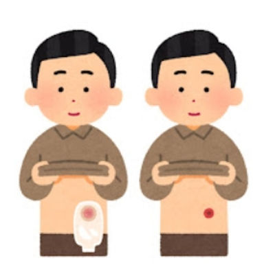 ストーマ周囲皮膚障害を防ぐ観察ポイントと対策